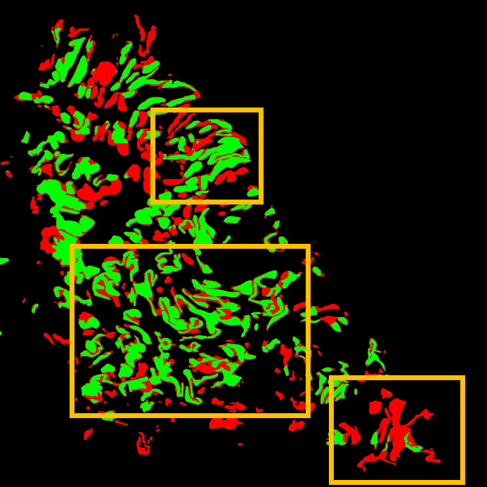 WSI 1 SegFormer Overlay