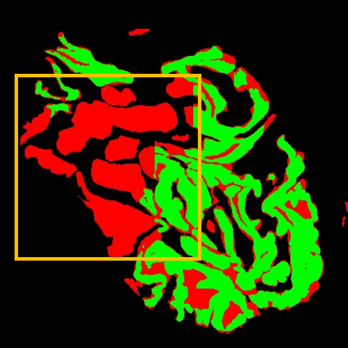 WSI 2 SegFormer Overlay